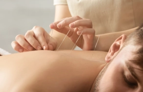 Acupuncture image